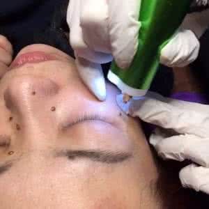 等離子雷射祛斑祛痣