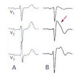 布魯格達綜合徵 布魯格達綜合徵