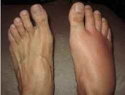 蜂窩性組織炎 蜂窩性組織炎