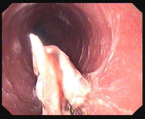 腦外傷后綜合征 腦外傷后綜合征