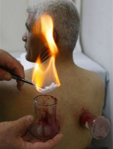 火罐療法 火罐療法