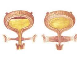 大小便失禁 大小便失禁