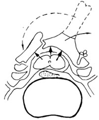 頸椎後縱韌帶骨化症