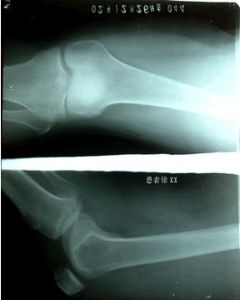 髕骨軟化 髕骨軟化