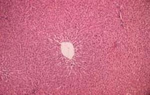 自發性細菌性腹膜炎 自發性細菌性腹膜炎