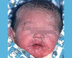 水泡型先天性魚鱗癬樣紅皮症