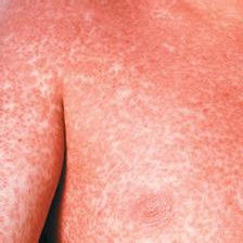 嗜酸性粒細胞增多性皮炎 嗜酸性粒細胞增多性皮炎