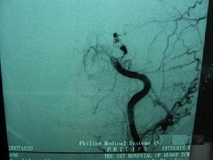 外傷性頸內動脈海綿竇瘺