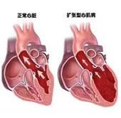 心肌病 心肌病