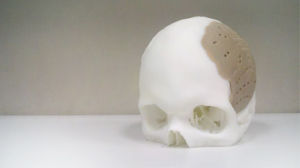 3D列印頭蓋骨可以完成破損頭蓋骨的修復