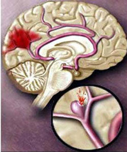 腦溢血先兆 腦溢血先兆