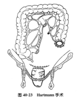 Hartmann手術 Hartmann手術