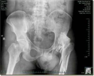 先天性髖位脫臼 先天性髖位脫臼