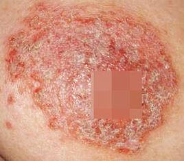 柏哲氏病 柏哲氏病