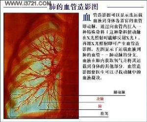 肺血管造影圖.