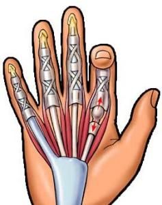 手指屈肌腱鞘炎 手指屈肌腱鞘炎