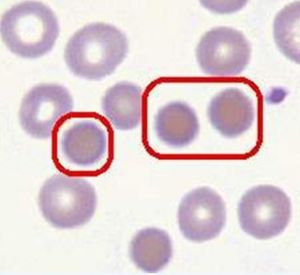 球形紅細胞
