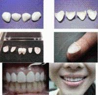 牙齒貼面 牙齒貼面