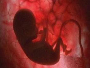 胎糞吸入綜合症