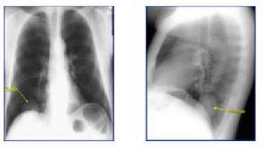 原發性支氣管肺癌