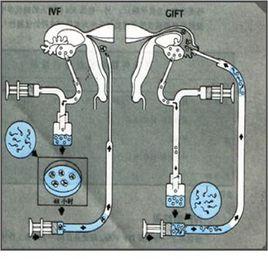 配子輸卵管內移植