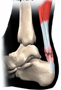 跟腱二斷 跟腱二斷