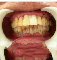 牙結石