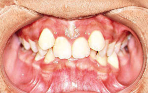 牙齒不齊 牙齒不齊