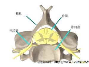 胸椎間盤脫出症 胸椎間盤脫出症