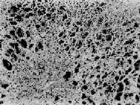 暴發性肝功能衰竭