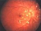 惡性高血壓視網膜病變