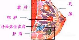 乳腺囊腫