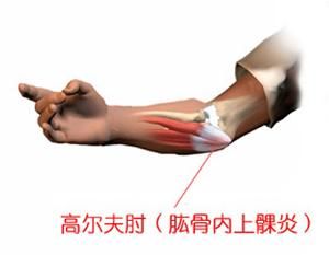 肱骨內上髁炎 肱骨內上髁炎