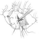 二尖瓣脫垂 二尖瓣脫垂