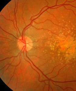 黃斑部病變 黃斑部病變