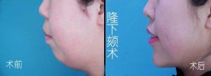 下頦整形