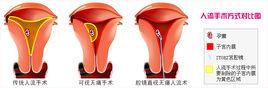 宮腔鏡取胚人流術