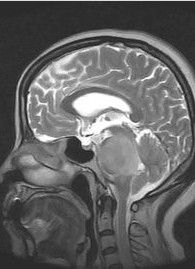 腦部膠質瘤 腦部膠質瘤