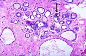 囊包性纖維症 囊包性纖維症