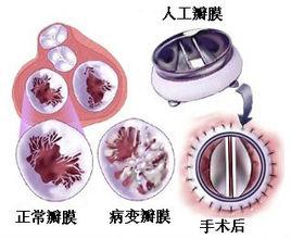 人工瓣膜 人工瓣膜