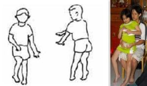 小腦萎縮症症狀