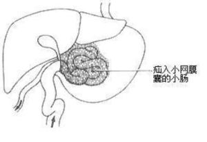 盲袢綜合徵 盲袢綜合徵