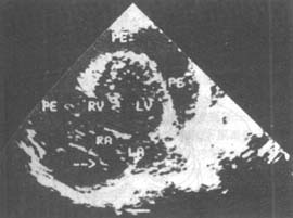 急性心包炎超聲