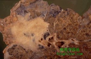 枸櫞酸桿菌肺炎