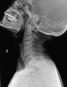 頸椎失穩 頸椎失穩