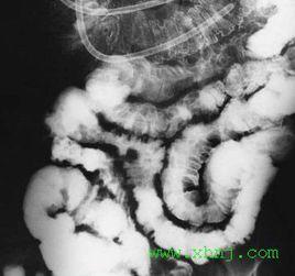 大腸克羅恩病 大腸克羅恩病