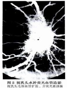 視神經乳頭水腫及視盤水腫