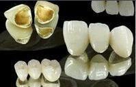 鈀金烤瓷牙 鈀金烤瓷牙