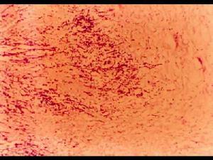 （圖）十二指腸類癌