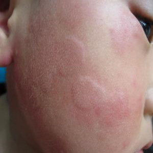 遇冷性蕁麻疹 遇冷性蕁麻疹